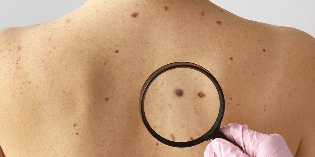 Nem todo melanoma aparece na pele - Guilherme Venturelli